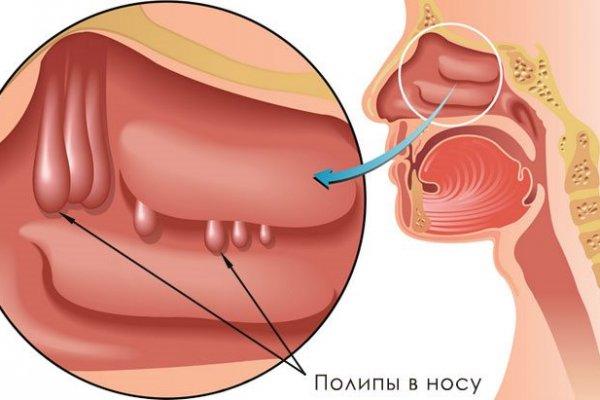 Симптомы и лечение полипов в носу: методы диагностики и терапии